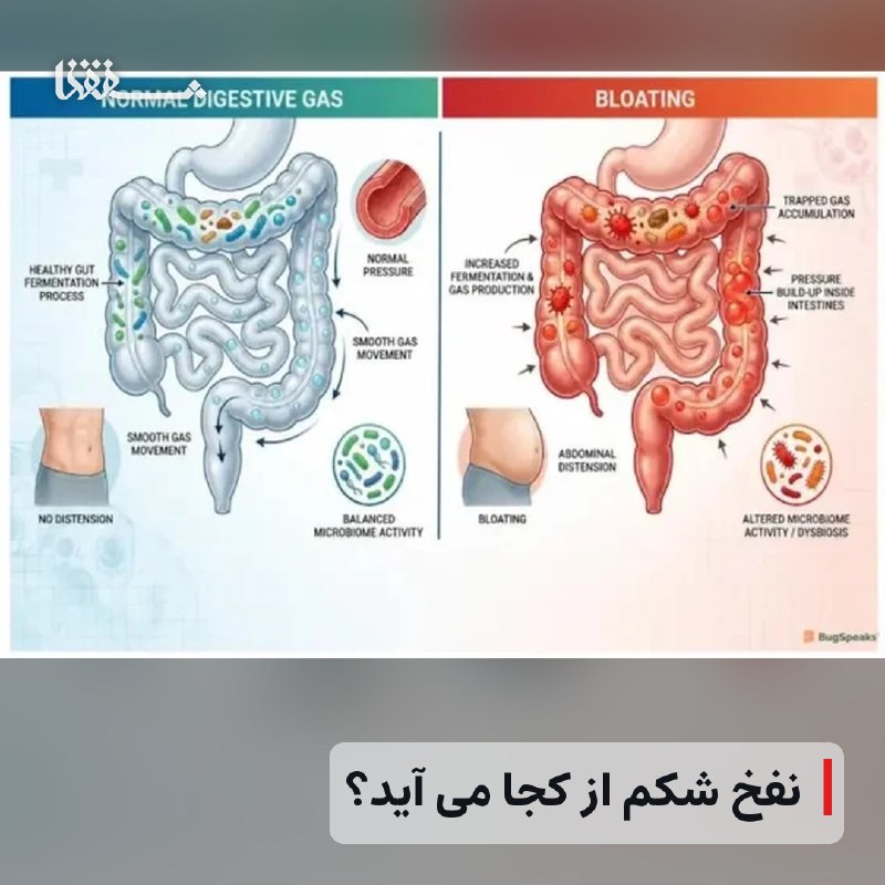 رفیق مدیا: 🔴 نفخ شکم از کجا می آید؟⬅️ وقتی غذا را با عجله می خورید، احتمال بلعیدن هوا بیشتر می شود. جویدن آدامس، نوشیدن با نی و مصر
