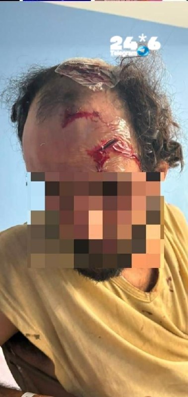 תקרית אלימה בסילוואן: גבר נפצע בראשו