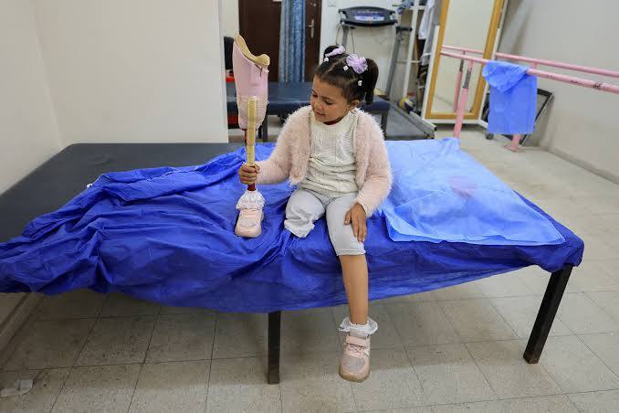 8000 בני אדם נקטעו במהלך המלחמה בעזה