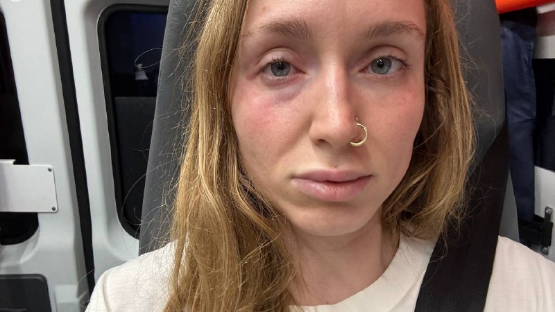 Прилетела с крапивницей по всему телу и отеком квике — уже в больнице Отменяю работу и встречи на ближайшие дни. Надеюсь, на всеобщее понимаете 🕊️Прилетела с крапивницей по всему телу и отеком квике — уже в больнице Отменяю работу и встречи на ближайшие дни. Надеюсь, на всеобщее понимаете 🕊️