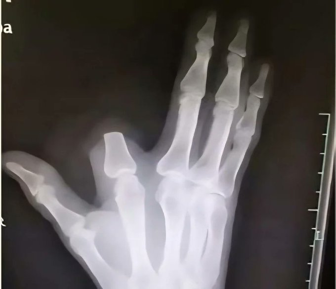 Fear moved faster than the venom.A farmer in China cut off his own finger after a snake bite, believing death was only minutes away.