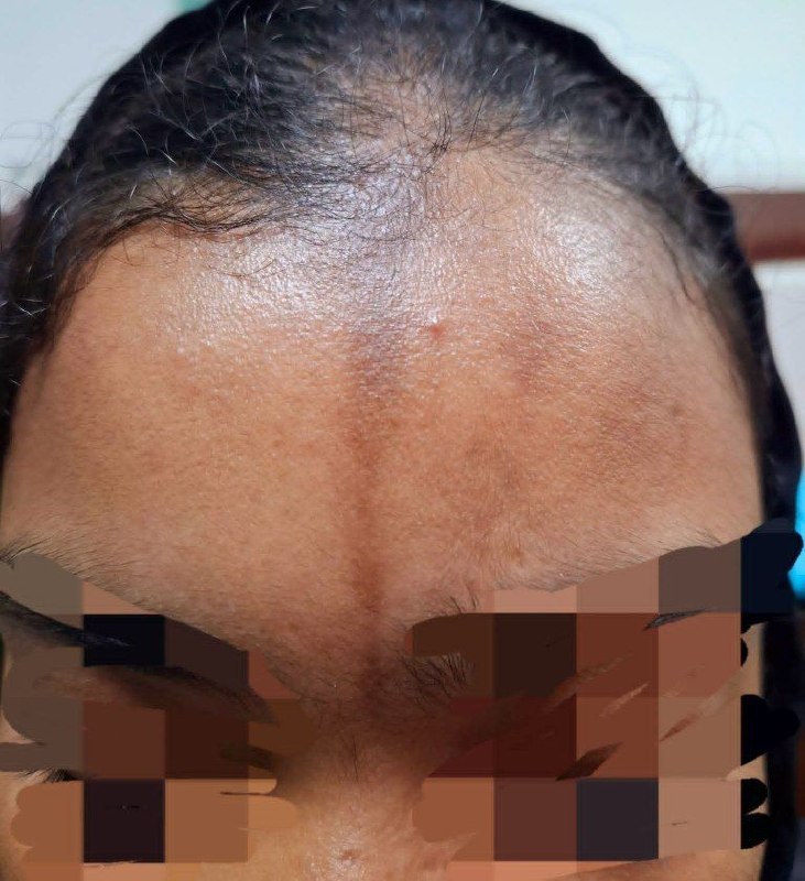 کانال طِب اَطفال: ⏺مورفهآی خطی (En Coup de Sabre) همراه با frontal scarring alopecia⬅️دختر،۱۴ ساله با شکایت اصلی: وجود یک پلاک خطی، فرورف