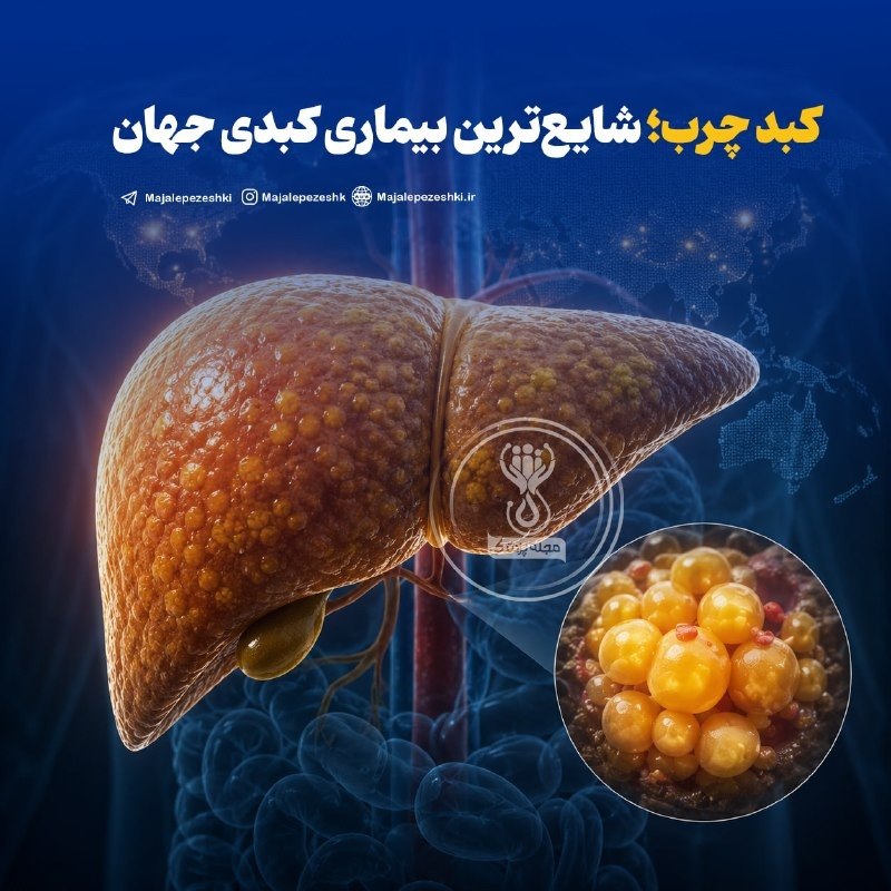 عصر دلفان: 🔴کبد چرب؛ شایع‌ترین بیماری کبدی جهان🔹تشخیص ابتلا به کبد چرب با انجام یک سونوگرافی ساده امکان‌پذیر است. افرادی که به این 