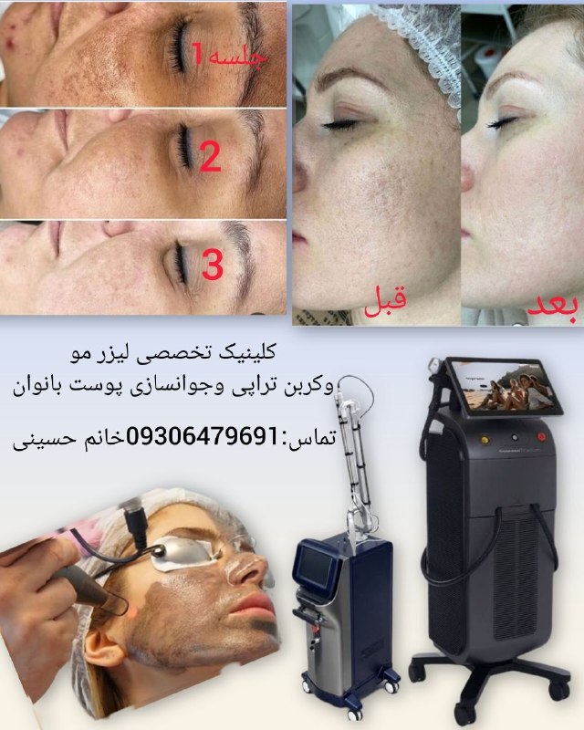 مریوان خبر️: 💠با یک تیر دونشان✴️قابل توجه کلیه بانوان عزیز فرصت طلایی فقط برای 10نفراول✅لیزر موهای زاید با دستگاه پیشرفته تیتانیوم پل