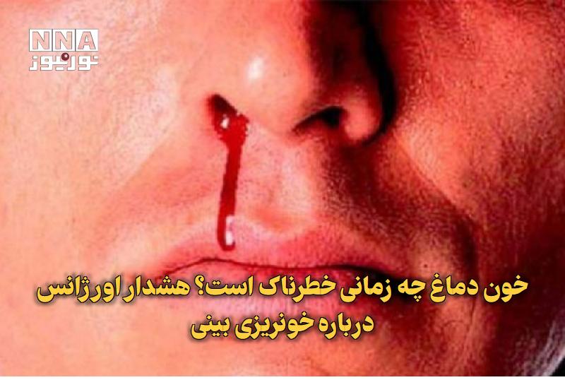 نورنیوز: ✅ خون دماغ چه زمانی خطرناک است؟ هشدار اورژانس درباره خونریزی بینی🔹 خونریزی بینی اگرچه در بیشتر موارد با اقدامات ساده در 