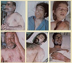 تی ال ال: میزبان محققان: Victims of the 1987 chemical attack on Sardasht, West Azerbaijan, Iran