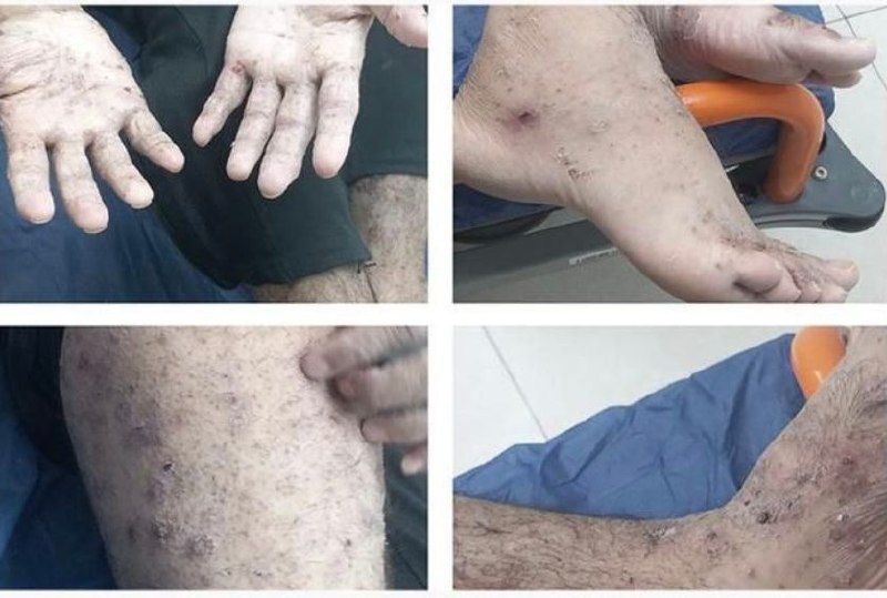 أسرى غزة في جانوت يعانون من حساسية ومرض جلدي معدٍ