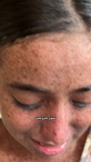 طفلة غزية تعاني مرضاً نادراً وتنمراً يهدد طفولتها
