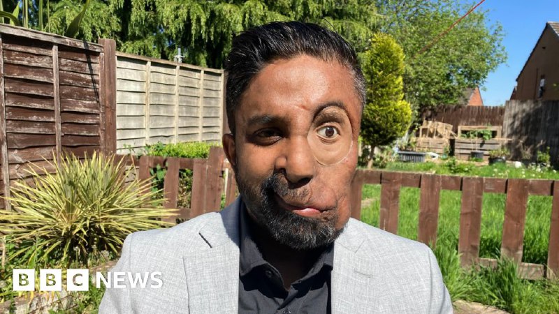 Facial disfigurement: 'I was refused service in a cafe because of my face'