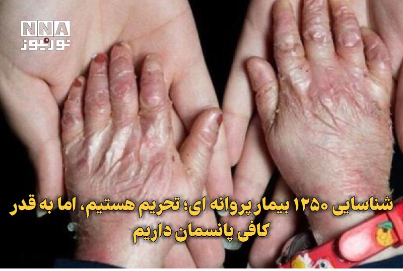نورنیوز: ✅ شناسایی ۱۲۵۰ بیمار پروانهای؛ تحریم هستیم، اما به قدر کافی پانسمان داریم🔹 مدیرعامل خانه «ای بی» (بیماران پروانه ای) گف