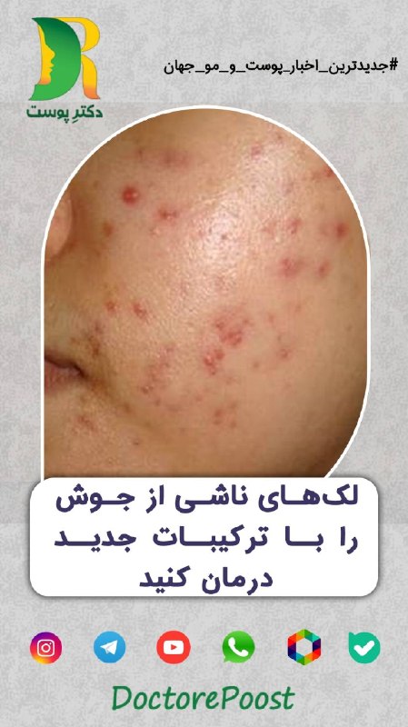 دکتر پوست | DoctorePoost: 🆕 #جدیدترین_اخبار پوست و موی جهان📆تاریخ انتشار در منبع: *خرداد 1405*ا🍃🍃🍃🍃🍃🍃🍃🍃🍃🍃🍃🍃🍃🍃🍃🟣لکهای تیره ناشی از جوش (PIHP) یکی