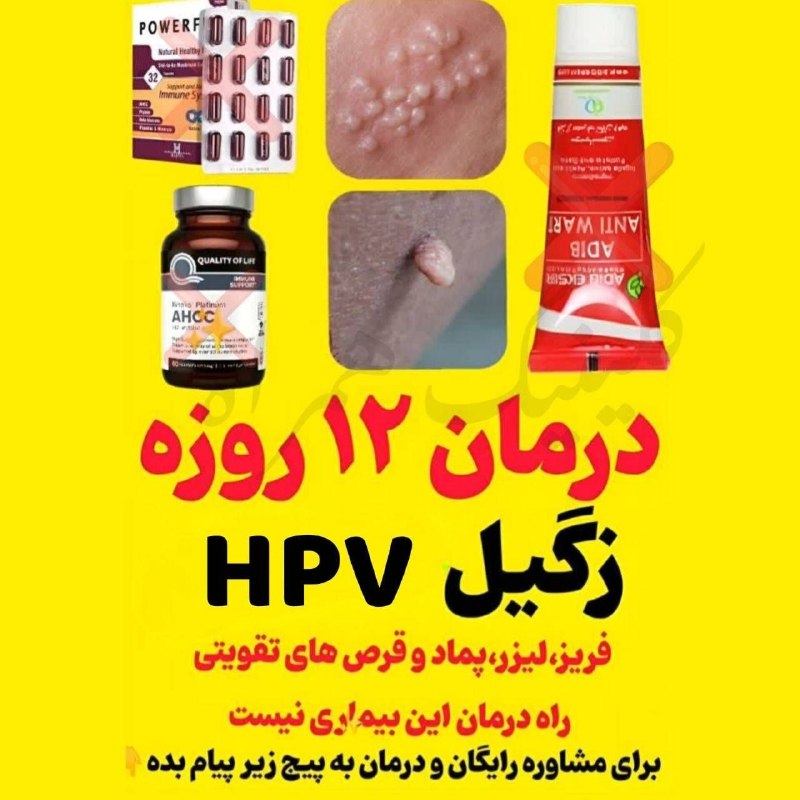 اخبار تهران: 🔹درمان 12 روزه🔹🔴 زگیل چهارمین ویروس خطرناک دنیاست که علاوه بر خودت به اطرافیانت هم منتقل میشه. نه لیزر، نه فریز و حتی قر