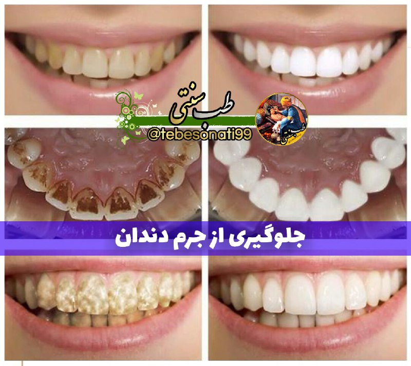 🍏طب سنتی🍏: جلوگیری از جرم دندان و سفید و ضد عفونی کننده دهان😁یک ق.چ سرکه سیب و نصف ق.چ نمک را در نصف لیوان آب گرم حل کنیدیک بار در