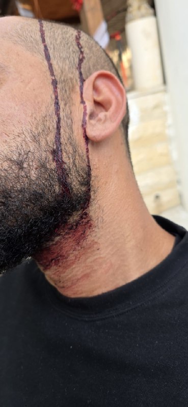 ההשפעות של תקיפת חיילי הכיבוש צעיר בעיירה רומנה, ממערב לג'נין.