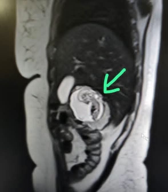 تیم پرستاری:مامایی🖤: کیس حاملگی خارج‌رحمی کبدی (Hepatic Ectopic Pregnancy) یک زن ۳۰ ساله از منطقه Bulandshahr در ایالت Uttar Pradesh هند، ماد