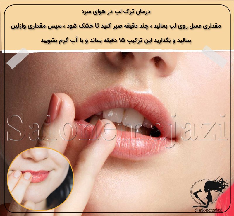 💋سالن زیبایی💅: 💄👄درمان ترک لب در هوای سرد✖️مقداری عسل روی لب بمالید ، چند دقیقه صبر کنید تا خشک شود ، سپس مقداری وازلین بمالید و بگذاری