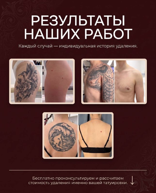 Надоела старая татуировка?