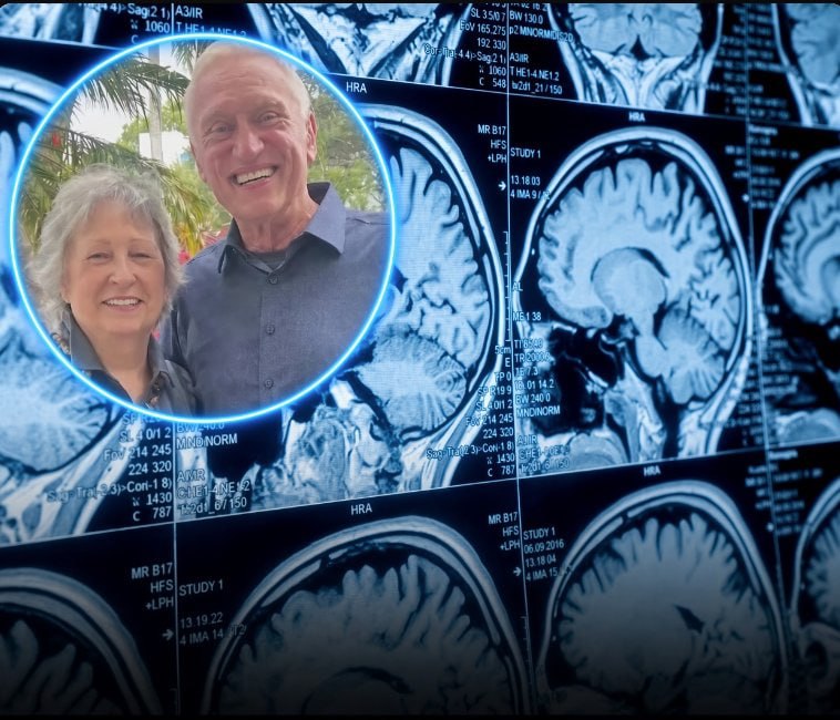 A Newly Approved Alzheimer’s Drug Cleared Amyloid Plaques in a Florida PatientScott Milinsky, a 79-year-old grandfather from Pompano Beach, Florida, received a diagnosis of early symptomatic Alzheimer’s disease, the same condition that had taken his father’s memory and life. Determined to pursue every available option, he became the second person in Florida to receive Kisunla (donanemab), an anti-amyloid infusion therapy developed by Eli Lilly and recently approved by the FDA.Over 18 months, Milinsky completed 18 infusions at Broward Health North’s Memory Disorder and Alzheimer’s Center. A follow-up PET scan then brought remarkable news: the treatment had cleared all detectable amyloid plaques from his brain.Physicians stress that Kisunla is not a complete cure. It does not address the tau tangles also linked to Alzheimer’s disease. Nevertheless, the removal of amyloid plaques has been shown to slow cognitive and functional decline, giving patients additional time and quality of life. Dr. Hazel Wiley, Milinsky’s physician, noted that clearing these plaques can help patients remain independent longer. Milinsky is now among more than 60 patients receiving the therapy at Broward Health.Clinical trial data support the potential of this approach. In a key study, donanemab produced substantial reductions in amyloid plaque levels on PET imaging, with many participants reaching amyloid-negative status.For Milinsky and others in similar circumstances, the outcome represents meaningful progress and renewed hope in the treatment of early Alzheimer’s disease.[Mintun, M. A., Lo, R. N., Duggan Evans, C., et al. (2021). Donanemab in early Alzheimer’s disease. New England Journal of Medicine, 384(18), 1691–1704. DOI: 10.1056/NEJMoa2100708]Science and facts💡