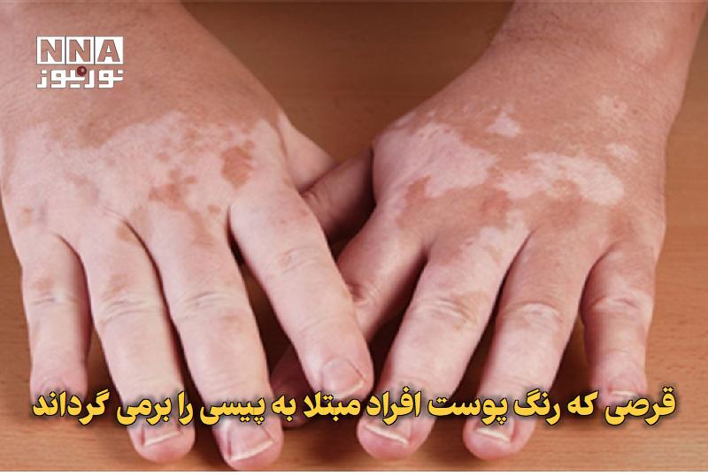 نورنیوز: ✅ قرصی که رنگ پوست افراد مبتلا به پیسی را برمی‌گرداند🔹 پژوهشگران می‌گویند یک قرص که باید روزی یک بار مصرف شود، به پوست ا