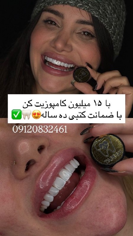 قیمت لحظه ای دلار طلا خودرو: با ۱۵ میلیون کامپوزیت کن اون هم با ضمانت ۱۰ساله🦷✅خدمات دنتال تپش شامل: _ ده سال ضمانت _ ده سال پالیش رایگان _ انجام کار