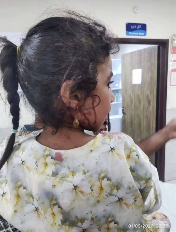 أطفال مصابون في هجوم أمريكي على حفل زفاف إيراني في مدينة سيريك.