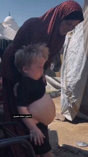 طفل غزاوي يعاني تضخماً في الكبد والكلى وسط تدهور صحي