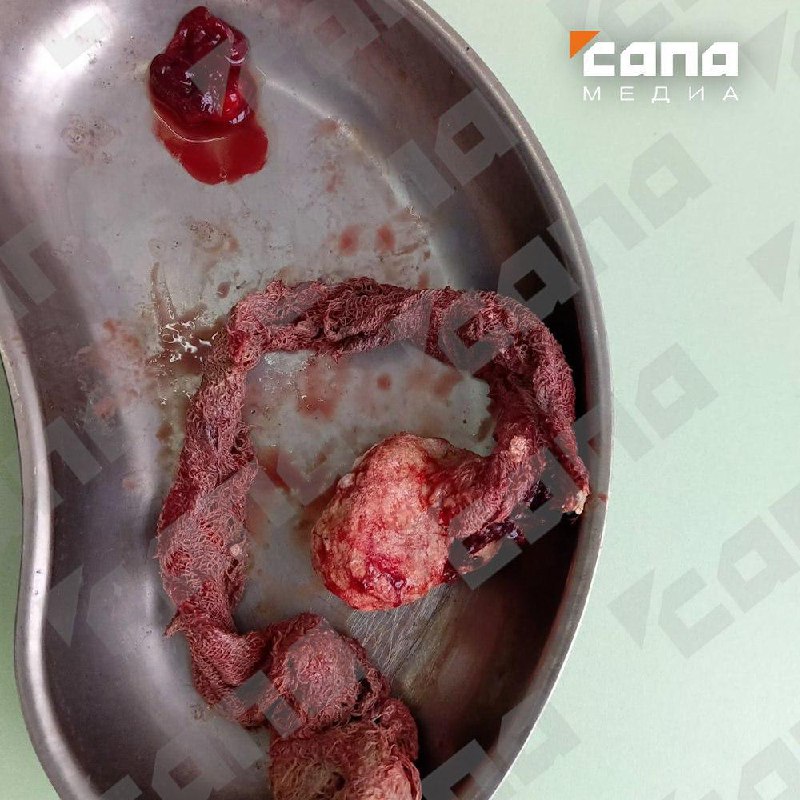 ⚡️ Женщина четыре года жила с забытой после операции салфеткой в животе фото