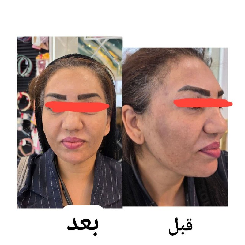 🌱🌱اندام جذاب🌱🌱: ببینین چطور لکهای تیره با اصلاح مزاج نابود شدن🤩قسمت جالبش اینه کرم لک هم مصرف نکردن@yassaamminn