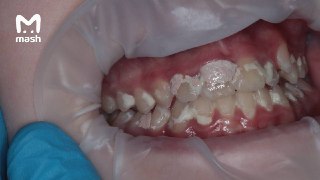 2,5 миллионов рублей должна будет заплатить семья 10-летней девочки из Москвы — чтобы восстановить её зубы после неправильного ухода за брекетами. Которые установили в стоматологической клинике без лицензии.По данным Mash, Лере поставили скобы для выпрямле
