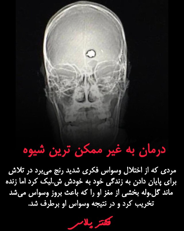 ویکی اسپیس: در دهه ۱۹۸۰، مردی ۱۹ ساله که به اختلال وسواس فکری-عملی شدید و مقاوم به درمان مبتلا بود، در تلاش برای خودکشی با یک تفنگ ب