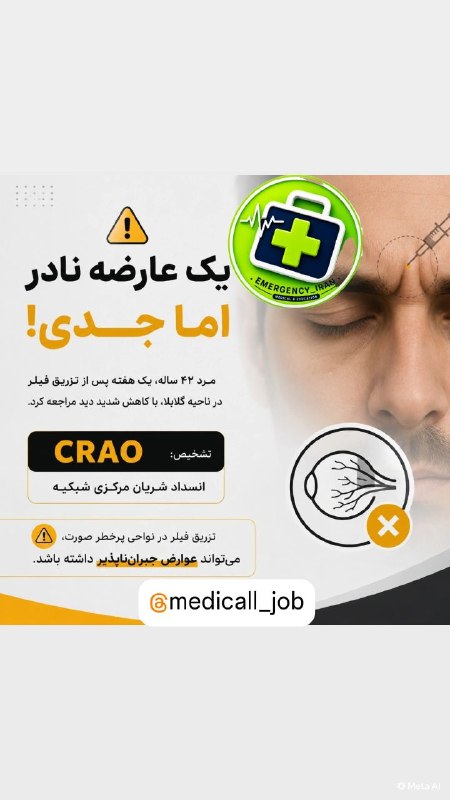 طب اورژانس EMERGENCY: ‏كيس عجيب و البته ناراحت كننده امروز درمانگاه رتين :‏بيمار آقاى ٤٢ ساله كه يك هفته قبل فيلر ناحيه گلابلا زده بود ؛ امروز