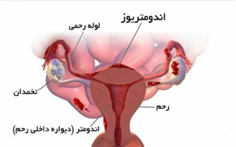 پزشک زناشویی: ۱. عادت ماهیانه نشدن: نشانه سندرم تخمدان پلی کیستیک، چربی بدنی کم، اختلال عملکرد تیروئید، استرس. شایع ترین دلیل قطع عادت