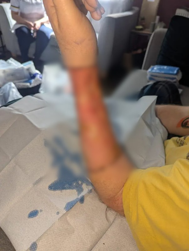 הרופאים גידלו את איבר מינו של גבר מרקמת ידיים. הבריטי פול לוקאס עבר פללופלסטיקה לאחר סרטן. המחלה התגלתה כשה…
