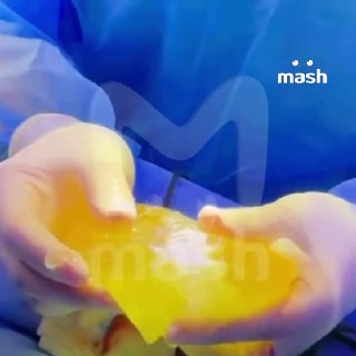 Силиконовая грудь взорвалась у блогерки из Уфы во время тренировки в зале. Разрыв импланта — последствия увеличения бюста в обычной районной больнице "мимо кассы". Да, так было можно и вот что из этого вышло. Блогерка-почти-миллионница Алина (имя мы измени