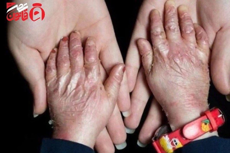 عصر قانون: ✳️ سواستفاده از رنج مردم در اینترنشنال؛ اینبار بیماران پروانه‌ای🔹شبکه اینترنشنال پس از پوشش اخبار مربوط به حملات به زیرس