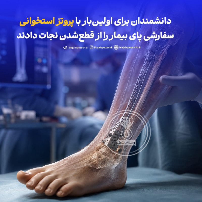 باسیاهکل💚: دانشمندان برای اولینبار با پروتز استخوانی سفارشی پای بیمار را از قطعشدن نجات دادند◽️پزشکان بیمارستانی در مادرید با ساخ