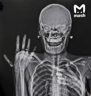 Рентген с обручальным кольцом — новый свадебный тренд, набирающий популярность в запретграмах среди российских парочек медиков. Перформанс запустили молодые из Новосибирска и Владивостока. Необычно, хайпово + может позволить себе только медперсонал. Ну или