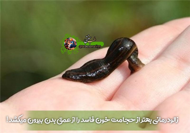 🍏طب سنتی🍏: خواص زالو درمانی در طب سنتی📌با زالودرمانی خون فاسد و کثیف خود را کامل از عمق بدن بیرون بکشید👌زالو با تصفیه و رقیق کردن خ