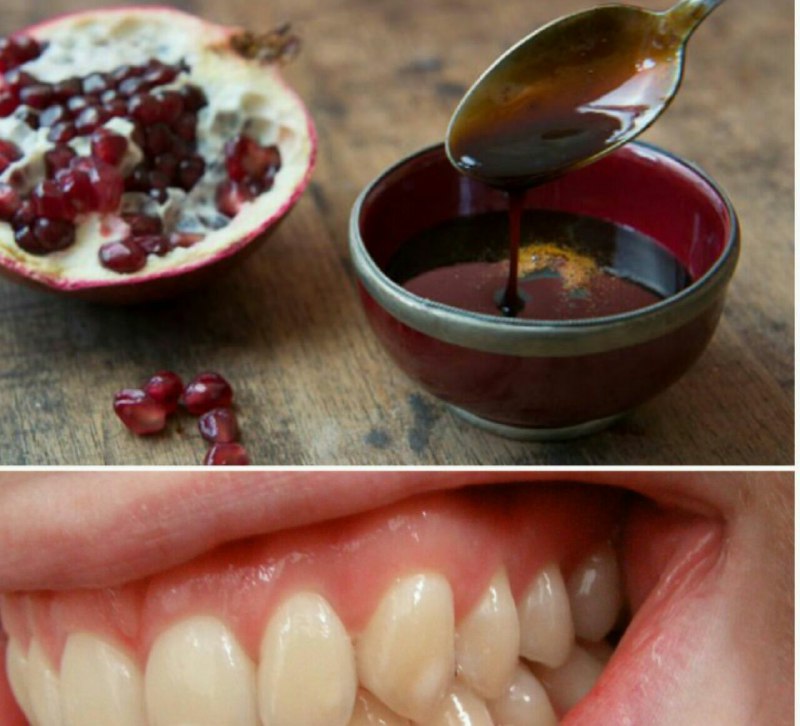 طب سنتی: رفع بوی دهان🤕کافیست شب ها مقداری رب انار را به لثه ها بمالید وسپس تا چند ساعت چیزی نخوریداینکار باعث از بین بردن عفونت ل