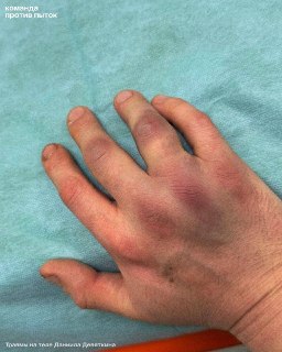 Силовики в ответ на обвинение в избиении мужчины сообщили, что он «сам бился головой о пол и сломал себе палец»Полицейские из Москвы, которых полтора года назад местный житель Даниил Девяткин обвинял в избиении в ОВД, утверждают, что он сам себе нанес повр