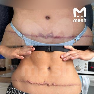 Больше десяти пациенток изуродовали в элитной клинике в Томске — со слов жертв, после операций у трёх пластических хирургов-мясников у них кривые носы, грудь разной формы и гнойные разъехавшиеся швы. Деньги за "красоту" возвращать отказываются.По данным Ma