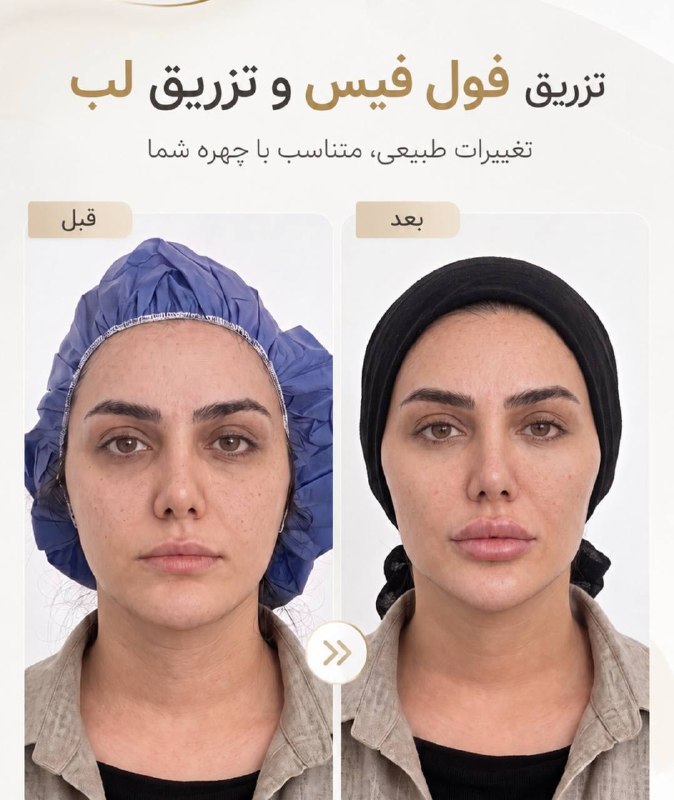 🟣 هزارپیشه 🟣: جشنواره بزرگ تابستونه مرکزفوتوناایلام رو ازدست ندید😍بوتاکس فقط و فقط ۶۵۰تومانفول فیس۱۳/۲۰۰فیلر لب یا زیرچشم ۵/۵۰۰تزریق ت