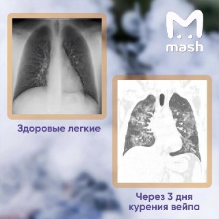 Лёгкие частично отказали у 19-летнего любителя вейпов из Саратовской области — теперь он никогда не сможет полноценно дышать. Парень не выпускал изо рта электронные дуделки на протяжении пяти лет. Зумера госпитализировали на скорой помощи в балаковскую бол
