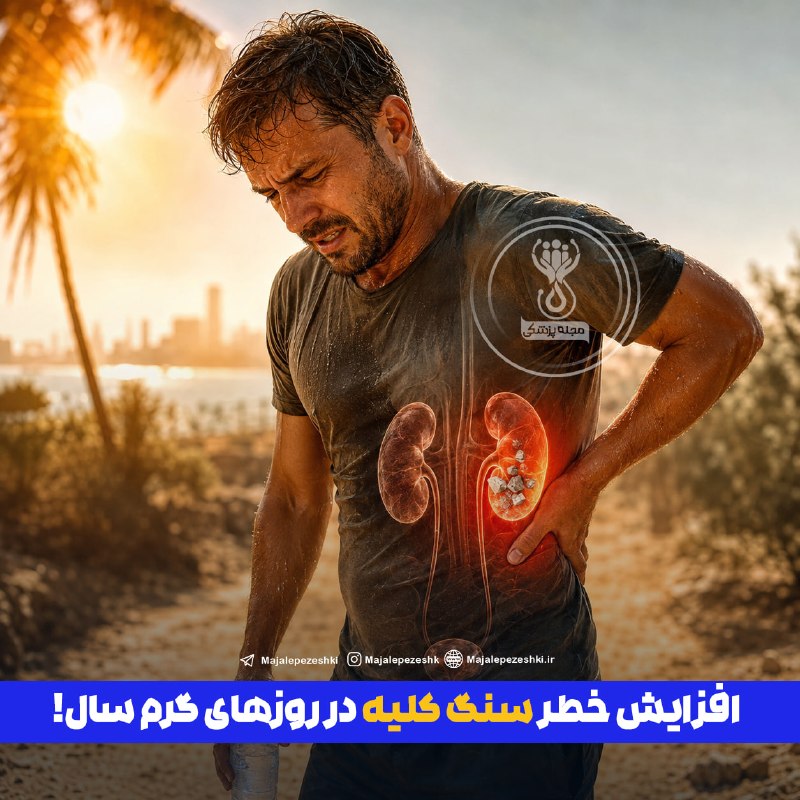 🌍شهر من اسلام آباد🌍: افزایش خطر سنگ کلیه در روزهای گرم سال!◽️گرما به‌تنهایی باعث ایجاد سنگ کلیه نمی‌شود، اما تعریق زیاد و کم‌آبی بدن با کاهش 