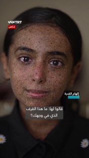 “I hope no one bullies me.” נערה פלסטינית סובלת ממחלה נדירה שמונעת ממנה לצאת לשמש ולשחק עם חבריה, בזמן שהיא…