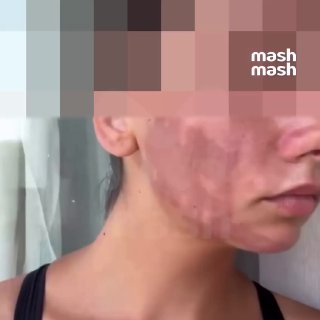 Глубокие ожоги на лице больше полугода не проходят у жительницы Краснодара — после процедуры аппаратной фототерапии у бюджетного косметолога на дому. Восстановление кожи обойдётся ей в сотни тысяч рублей. Фотограф Влада из Краснодара хотела избавиться от к