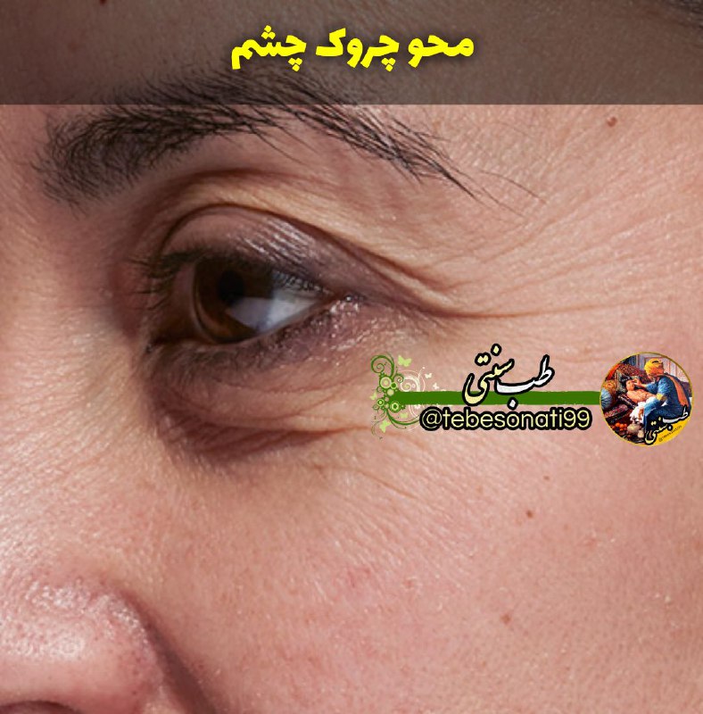 🍏طب سنتی🍏: محو چروک چشم👇پوره سیب زمینی را با یک قاشق عسل ترکیب کنید زیر چشم بمالید بعداز۲۰دقیقه با آب بشویید. تیرگی اطراف چشم و چین
