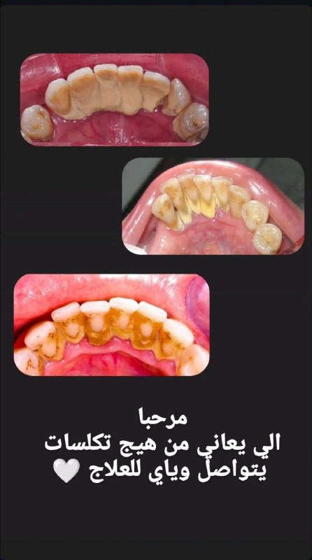 إعلان تنظيف أسنان مجاني في عيادات بيارق العميد