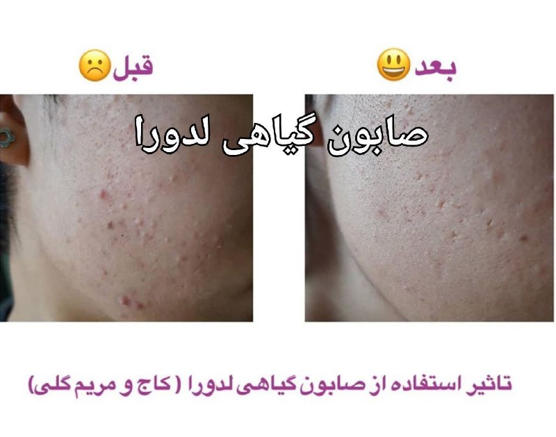 https://t.me/Arayeshibita_anita: تاثیر صابون گیاهی کاج و مریم گلی🧼