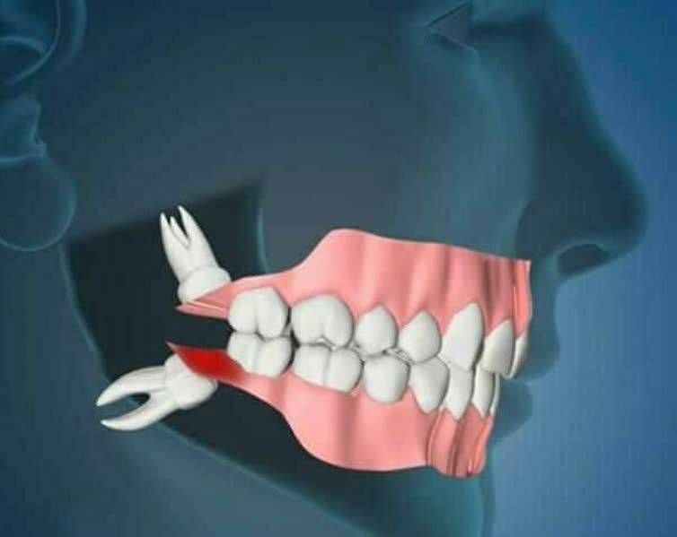 عصر همدان: 🔴دندان عقل را بکشید!🔹دندان عقل با توجه به اینکه در آخرین ردیف دندان‌ها رشد می‌کند و جای کمی برای رشد آن وجود دارد به دند
